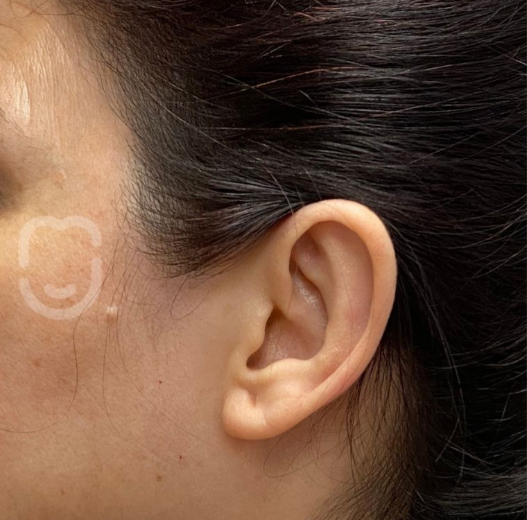 Otoplastia post