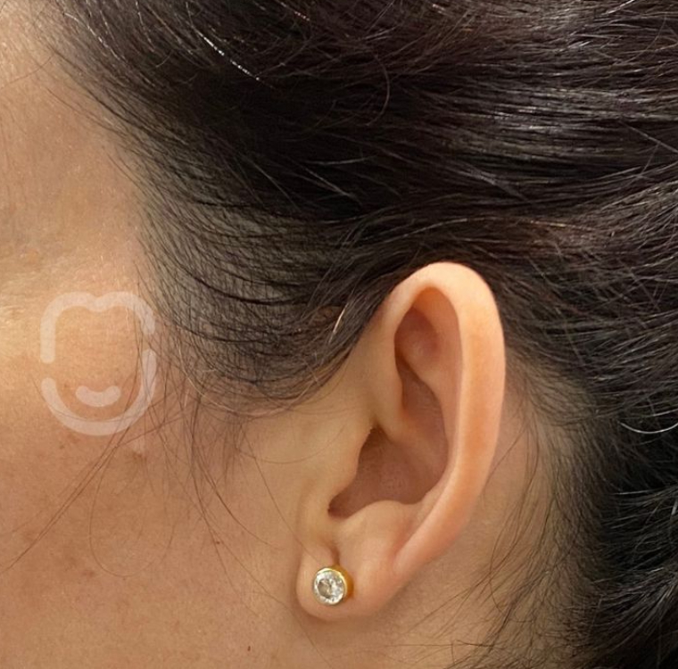 Otoplastia pre