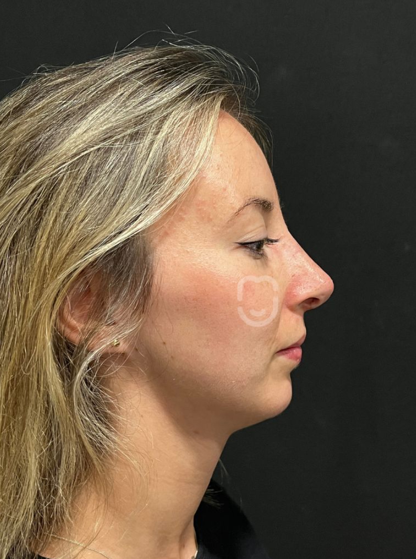 RINO 12 PERFIL POST