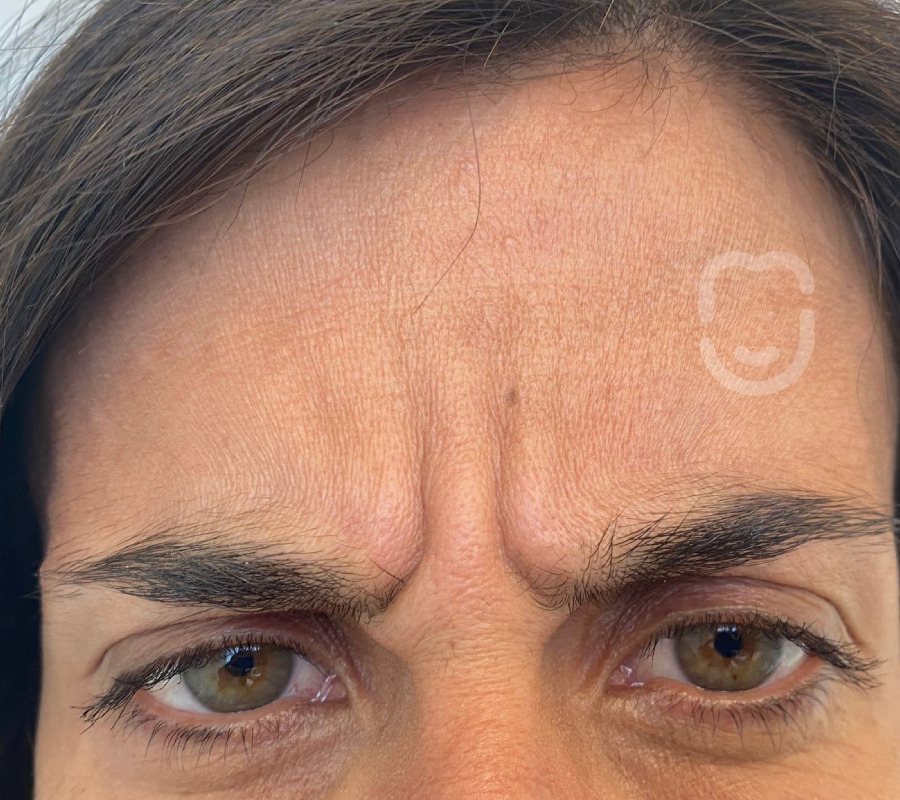 Neuromodulador entrecejo pre