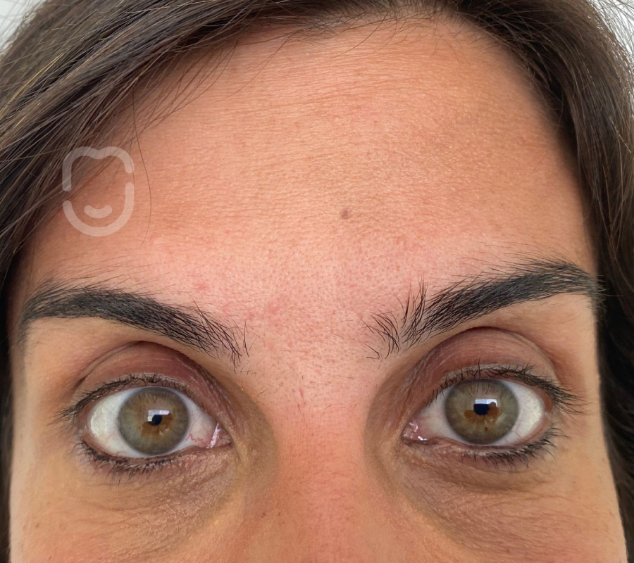 Neuromodulador frontal post
