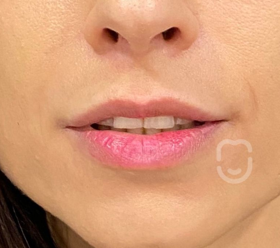 labio 2 pre