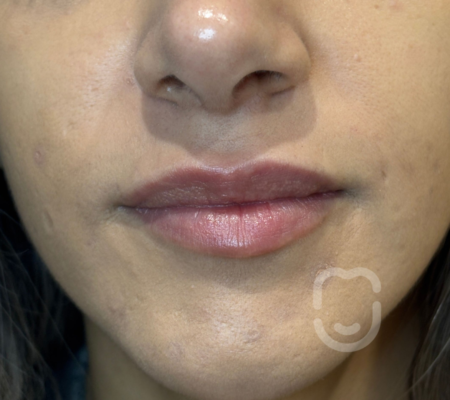 labios post 1